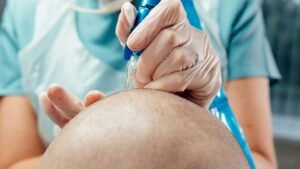 Alternatives to hair transplant