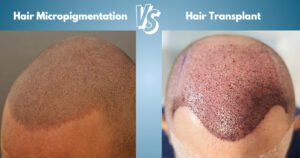 Hair Micropigmentation vs. Hair Transplant